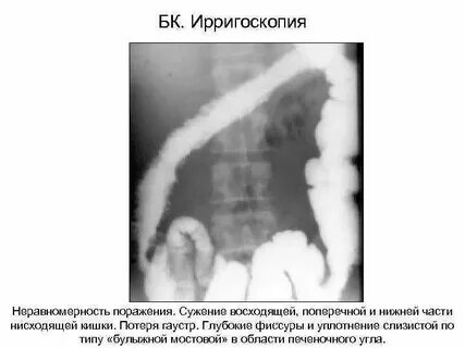Хронический стеноз