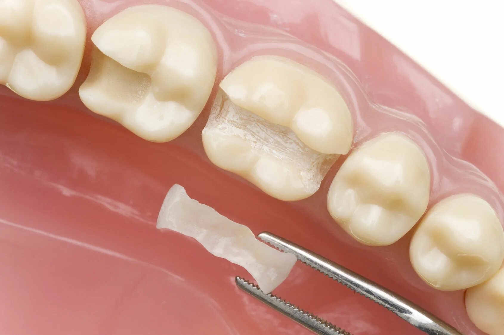 Микропротезы виниры вкладки стоматология. Микропротезы несъемные. Цельнокерамическая вкладка. Несъёмные мостовидные шинирующие протезы.