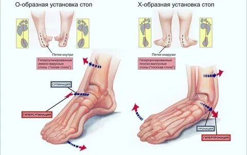 Болят ноги ступни и пятки причины