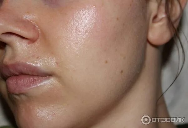 Как выглядит жирная кожа Картинки КОЖА СТАЛА ТОНЬШЕ