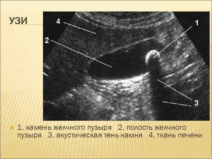 Сгустки в желчном пузыре. Гиперэхогенный желчный пузырь УЗИ. Конкременты желчного пузыря УЗИ. Акустическая тень на УЗИ желчного. Камни в желчном пузыре УЗИ.