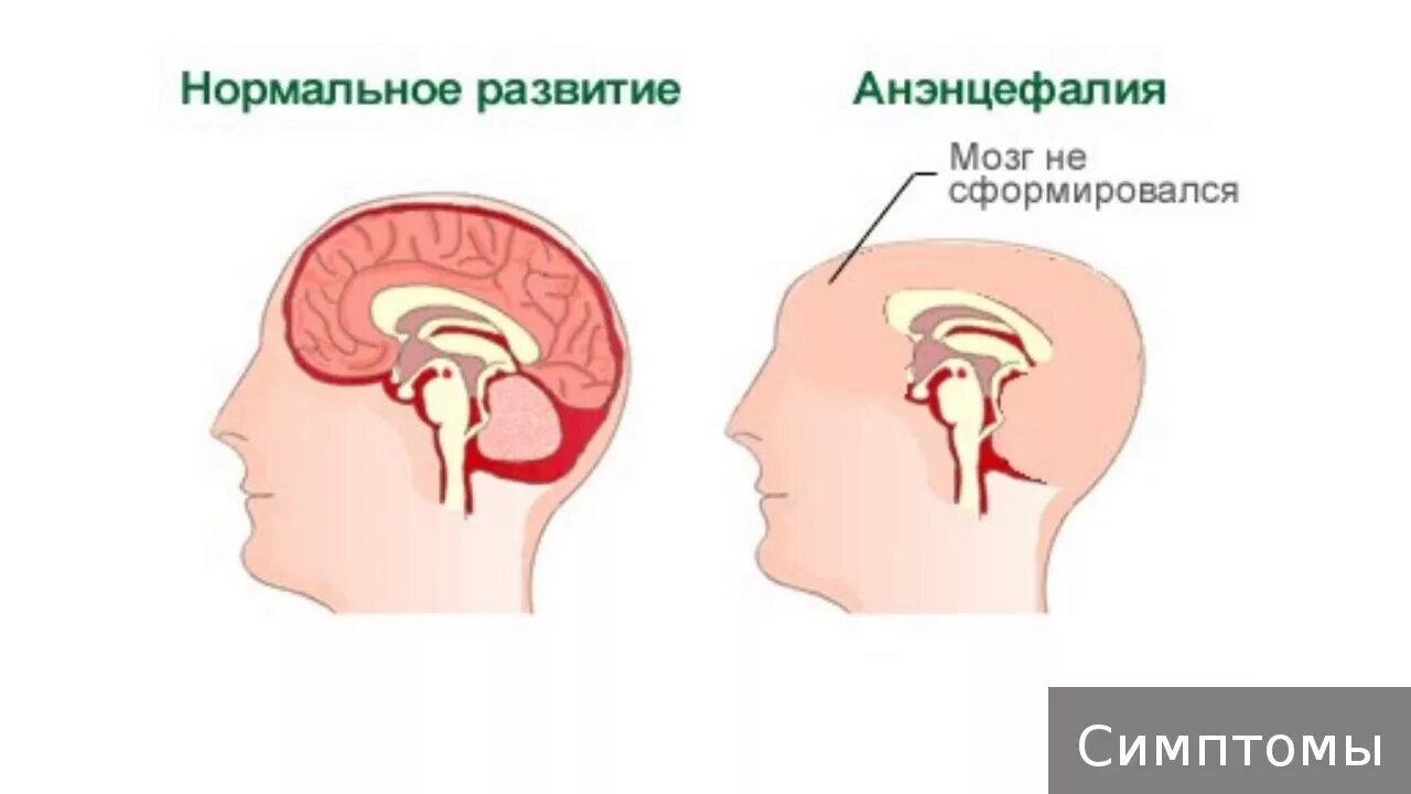 Внутриутробное недоразвитие головного мозга. Врожденные пороки развития головного мозга.