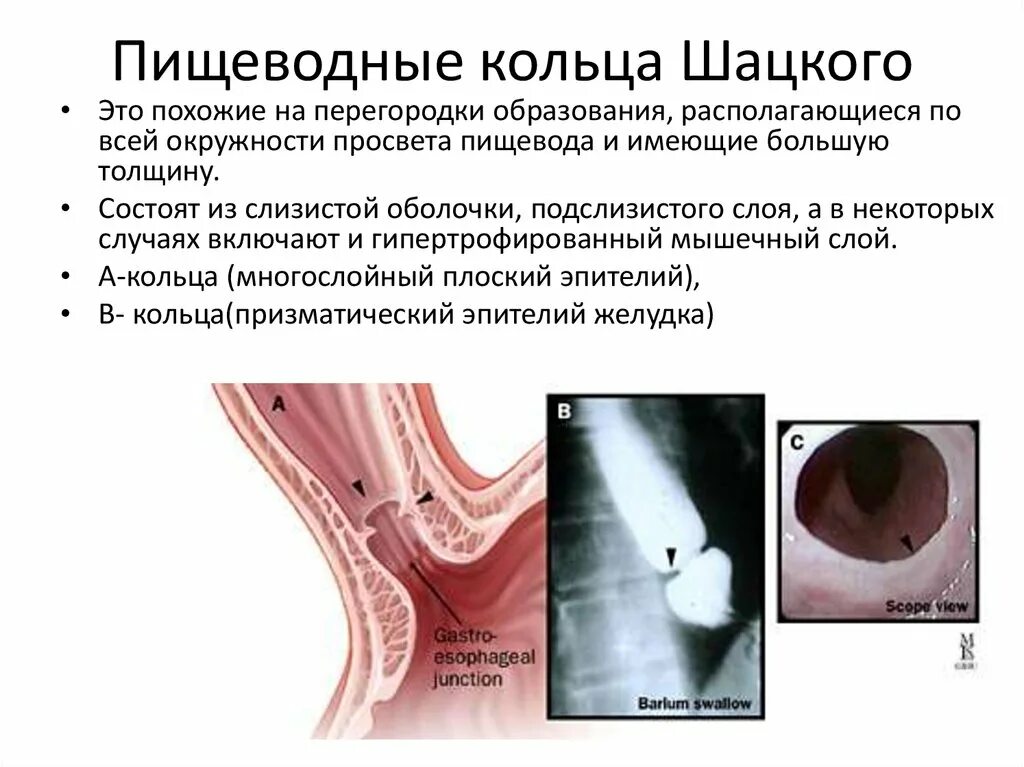 Пищевод шацкого. Сужение пищевода кольцо Шацкого. Кольцо пищевода Шацкого стриктура. Кольцо Шацкого эндоскопическое описание.