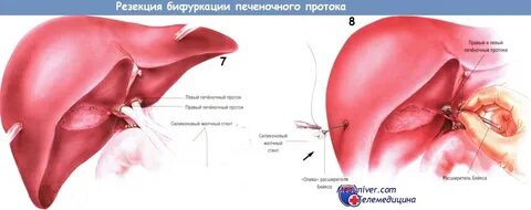 Операция протоков печени