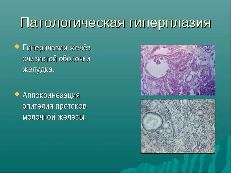 Фиброзно железистая ткань высокой плотности