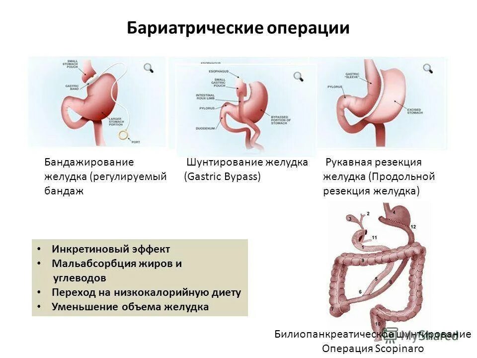 Умер от резекции желудка. Шунтирование желудка схема операции. Показания к бариатрической операции на желудке. Бариатрическая операция гастрошунтирование. Бариатрическая операция резекция желудка.