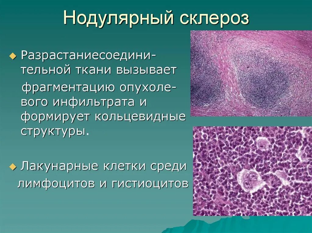 Клетки Ходжкина гистология. Лимфогранулематоз нодулярный склероз микропрепарат. Лимфома Ходжкина гистология. Ходжкинская лимфома микропрепарат. Лимфоидная опухоль