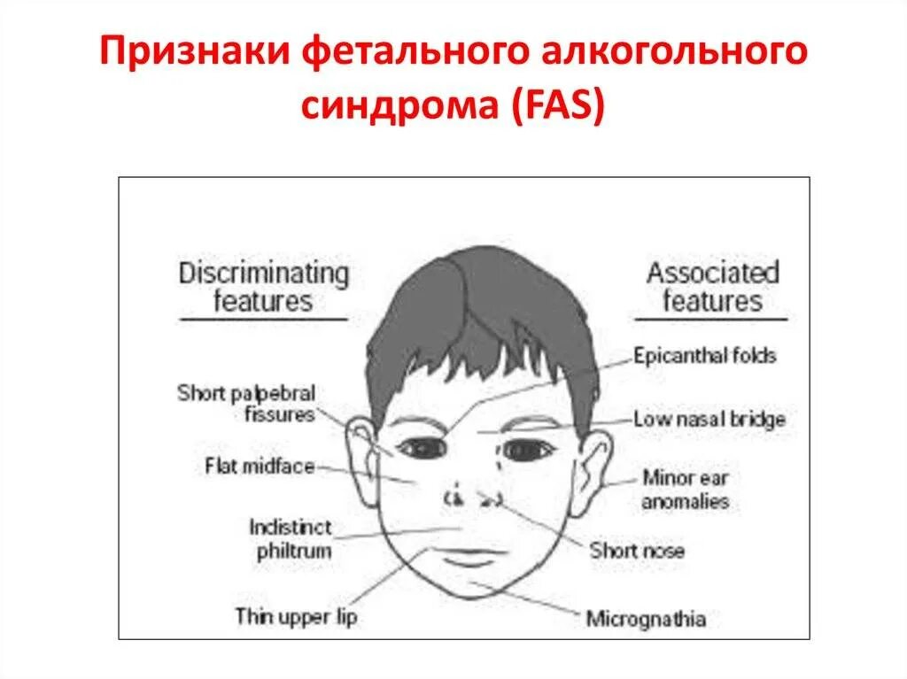 Алкогольный синдром у взрослых. ФАС фетальный алкогольный синдром. Фета алкогольный синдром. Фетальный алкогольный синдром у детей внешние признаки. Фетальный алкогольный синдром у детей.