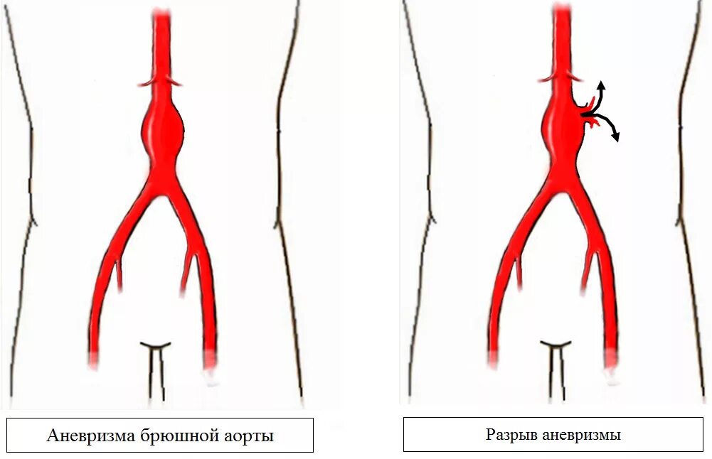 Аневризма показания к операции. Аневризма брюшной аорты разрыв. Аневризма аорты в брюшной полости разрыв. Атеросклероз брюшной аорты. Аневризма грудного отдела аорты симптомы разрыв.