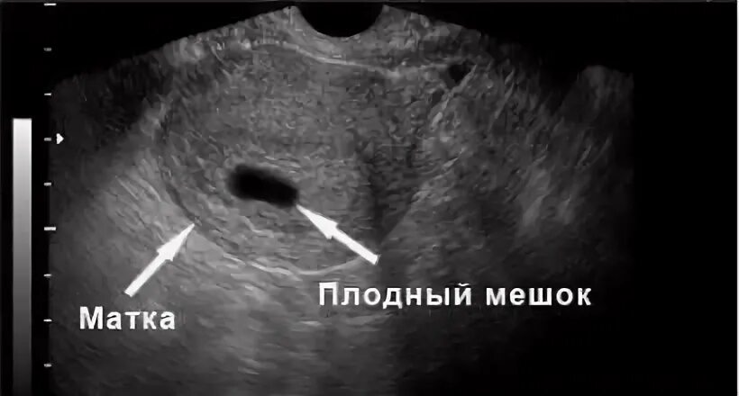 УЗИ плодное яйцо 6 недель. УЗИ беременности 6-7 недель плодное яйцо. УЗИ анэмбриония 5 недель. Без плодного яйца