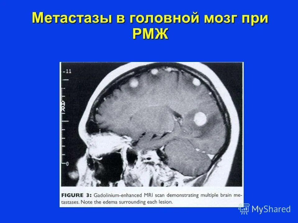 Метастатические опухоли головного мозга. Метастазы в головном мозге. Метастатическое поражение головного мозга.