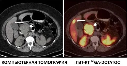 Кт показывает метастазы