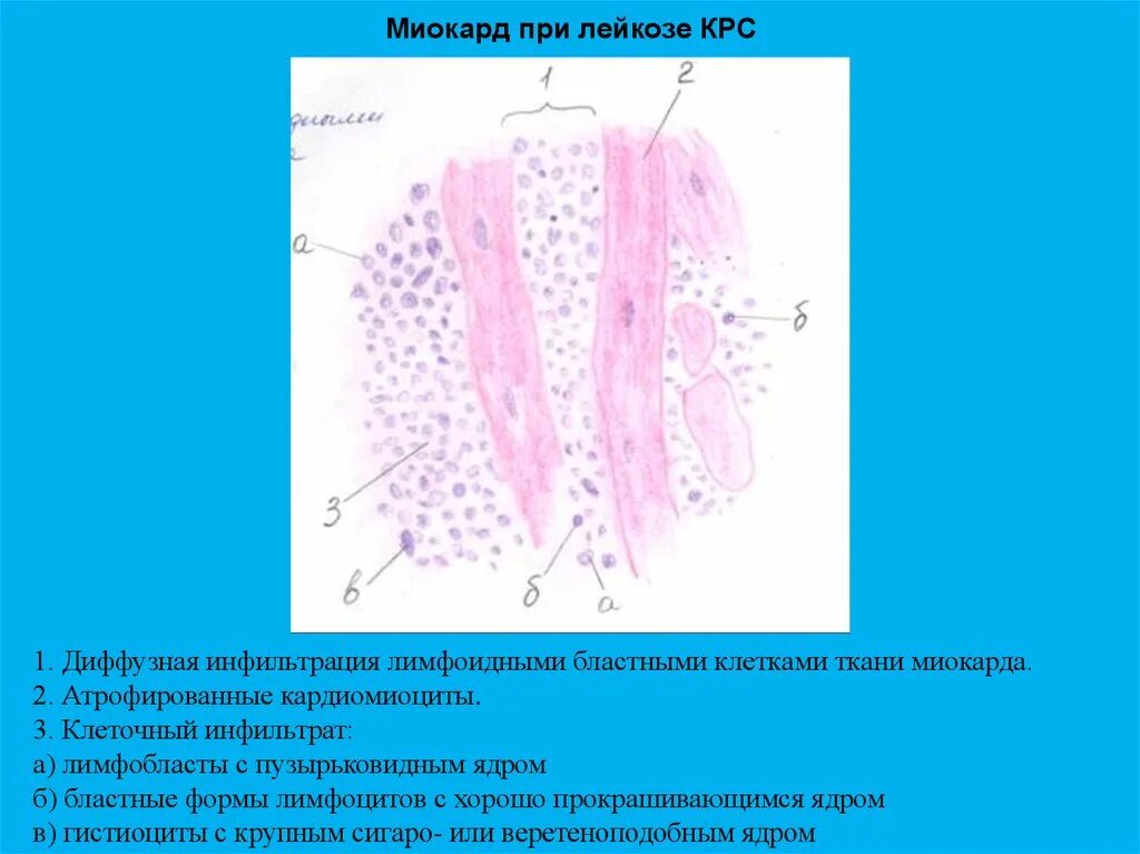 Т клеточный пролимфоцитарный лейкоз. Лейкоз сердце. Лейкоз сердце. Острые лейкоз характеризуется. Лейкоз сердце.