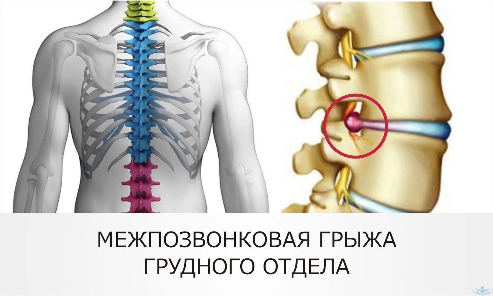 Спинной форум. Грыжа грудного отдела позвоночника. Межпозвонковые грыжи в грудном отделе симптомы. Межпозвоночная грыжа грудного отдела. Грыжа в грулном лтлеоп позаоночника.