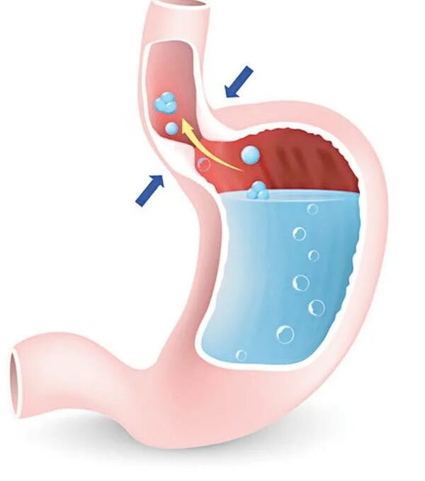 Заброс кислоты из желудка в пищевод