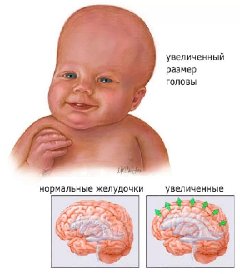 Гидроцефалия головного мозга у младенца. Симптомы очагового поражения головного мозга у новорожденного. Водянка в головном мозге у ребенка новорожденного. Гидроцефальный синдром симптомы. Почему в голове вода