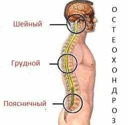 Остеохондроз грудного отдела мкб