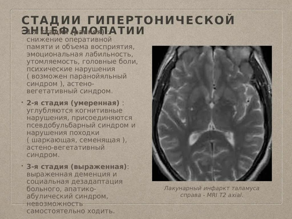 Острая гипертоническая энцефалопатия мрт. Гипертоническая мультиинфарктная энцефалопатия мрт. Гипертензивная энцефалопатия мрт. Острая гипертензивная энцефалопатия кт.