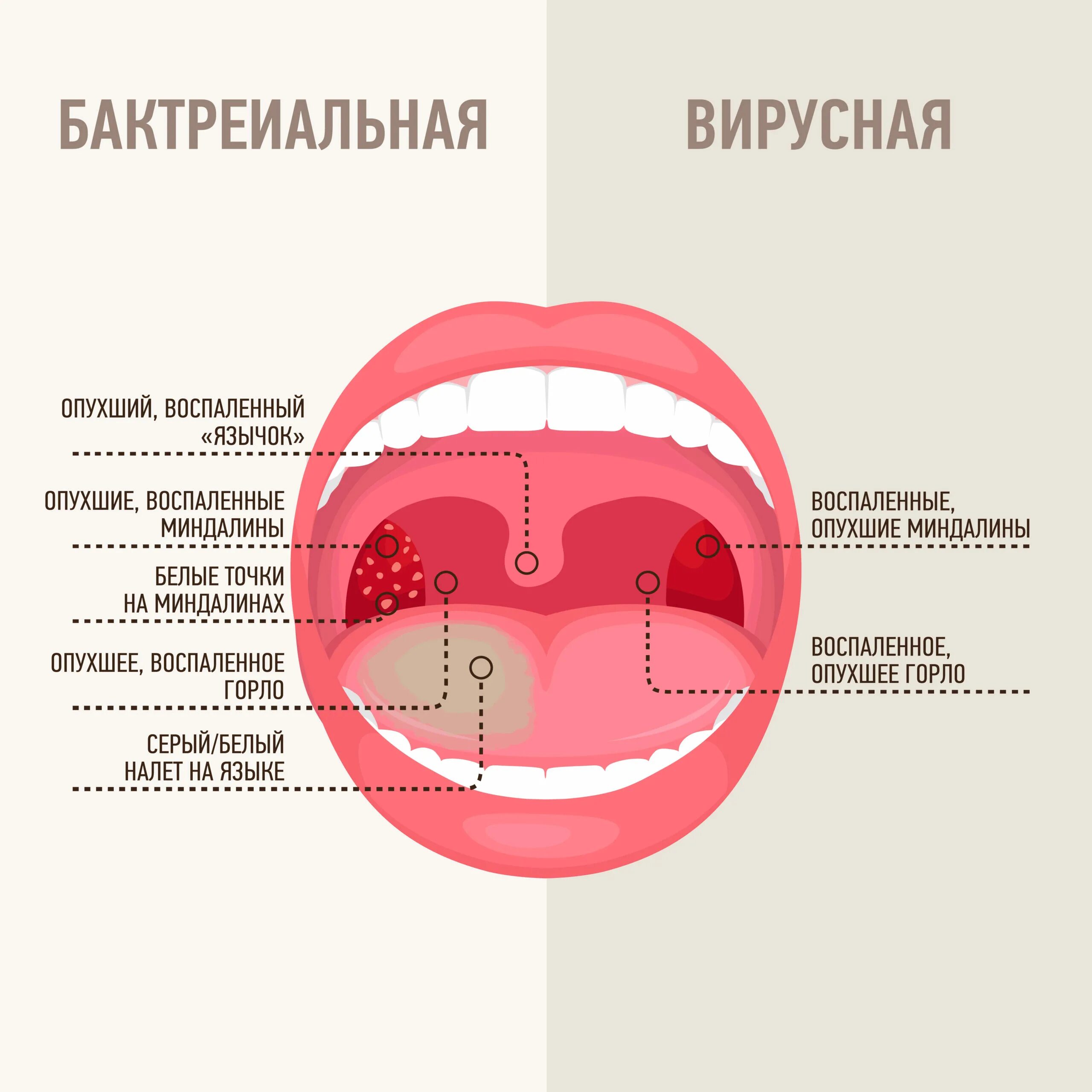 Сколько при ангине держится температура у взрослого. Виру ная и бактериальеая ангина. Вирусная и бактериальная инфекция горла. Ангина вирусная или бактериальная.