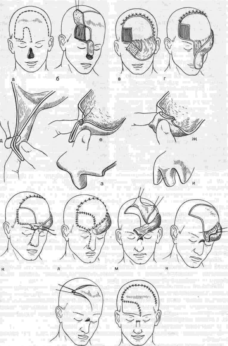Ткани лба. Разрез в челюстно лицевой хирургии. Реконструктивные операции ЧЛО. Хирургический разрез кожи. Восстановительная хирургия ЧЛО.