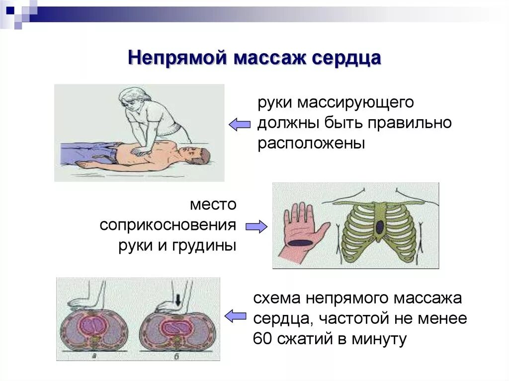 Частота закрытого массажа сердца. Алгоритм проведения наружного непрямого массажа сердца. Схема проведения непрямого массажа сердца. Положение рук при проведении непрямого массажа сердца. Опишите методику непрямого массажа сердца.