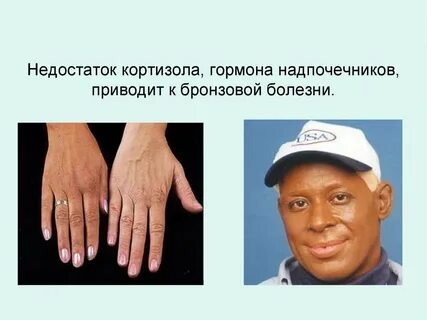 Недостаток гормона симптомы