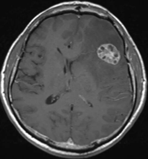 Меланома метастазы в мозг. Метастазы меланомы в головной мозг кт. Метастазы меланомы в головной мозг мрт. Опухоль головного мозга метастазы.