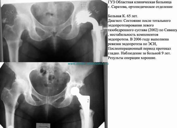 Ревизионное эндопротезирование тазобедренного сустава. Эндопротезирование ТБС операция. Ревизия эндопротеза тазобедренного сустава. Эндопротез Сиваша тазобедренного сустава. Эндопротезирование тазобедренного отзывы пациентов