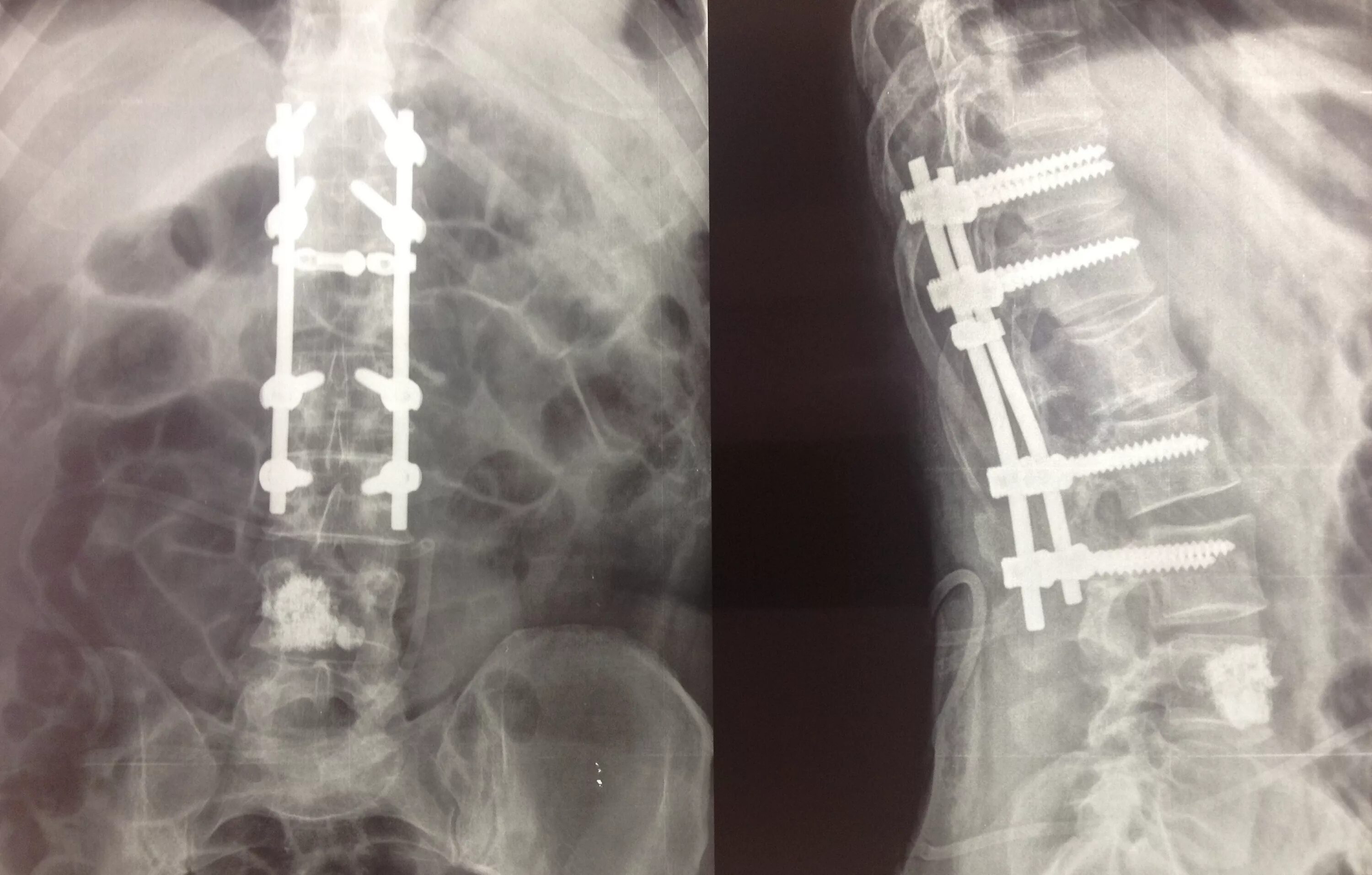 Операция фиксация позвоночника. Вертебропластика s1 позвонка. Транспедикулярная фиксация l3 l4. Остеосинтез позвоночника l1 транспедикулярной. Транспедикулярная фиксация позвоночника рентген.