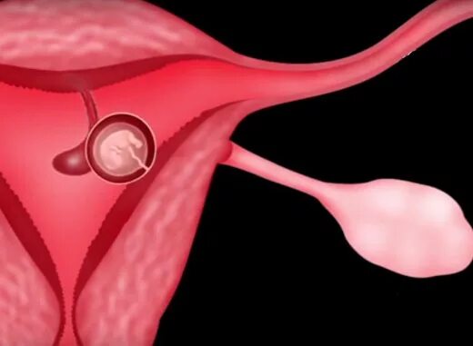 Полип в матке можно беременеть. Эхограммы полип эндометрия. Полип цервикального канала ухи. Полипы эндоцервикса на узи. Полип в матке можно беременеть.