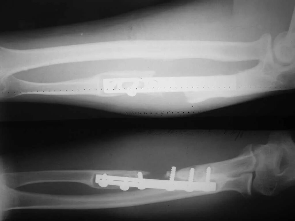 костная мозоль после перелома лучевой кости