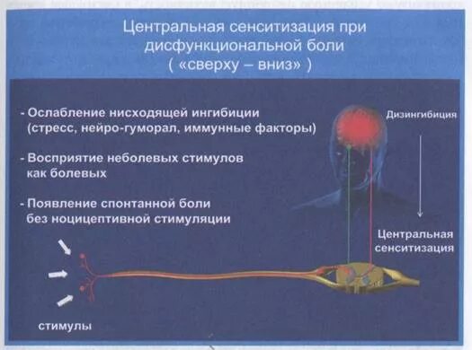 Повторяющиеся эпизоды центральной сенситизации
