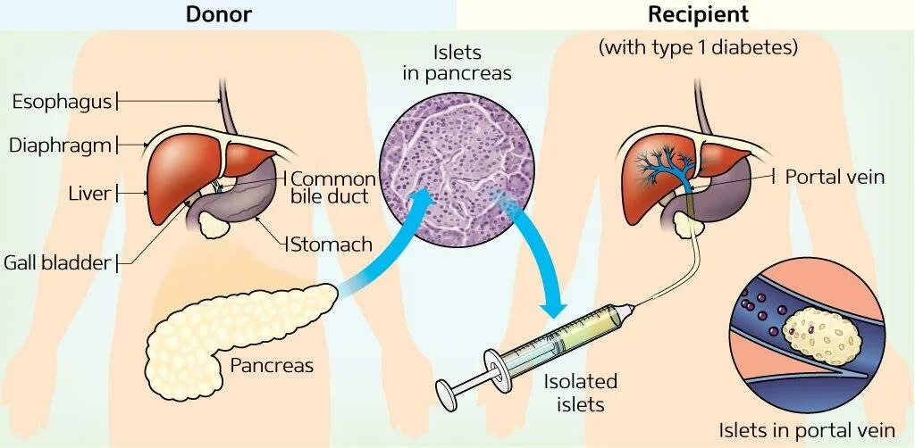 Диабет пересадка поджелудочной железы. Трансплантация поджелудочной железы при сахарном диабете 1 типа. Трансплантация клеток поджелудочной железы. Трансплантология поджелудочной железы. Органная трансплантация поджелудочной железы.