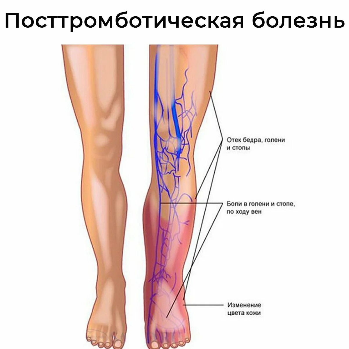Болит большая берцовая. Трофические язвы на варикозных венах. Тромбофлебит кубитальной вены. Поверхностный флебит, тромбофлебит. Флебит тромбофлебит флеботромбоз.
