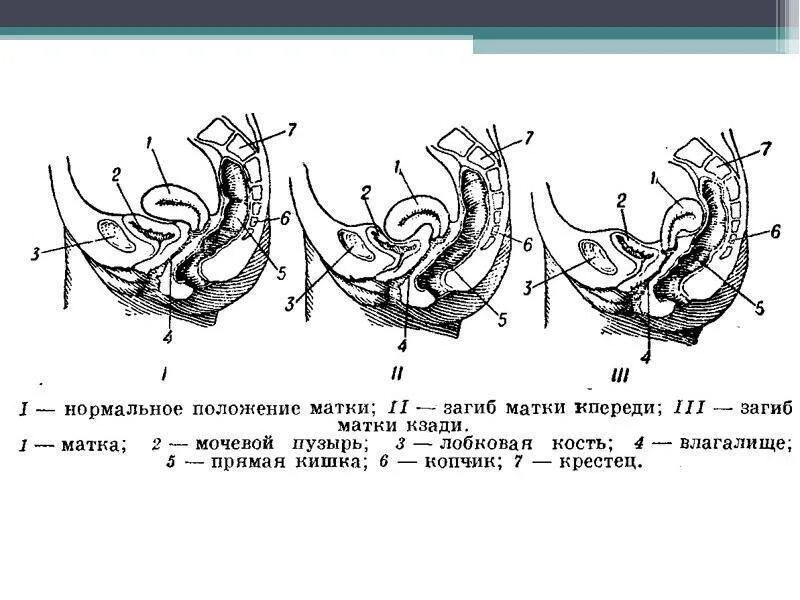 Загиб матки симптомы. Загиб матки симптомы