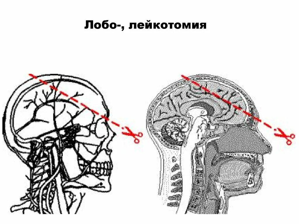 Фронтальная Лоботомия. Трансорбитальная Лоботомия. Лоботомия геометрия