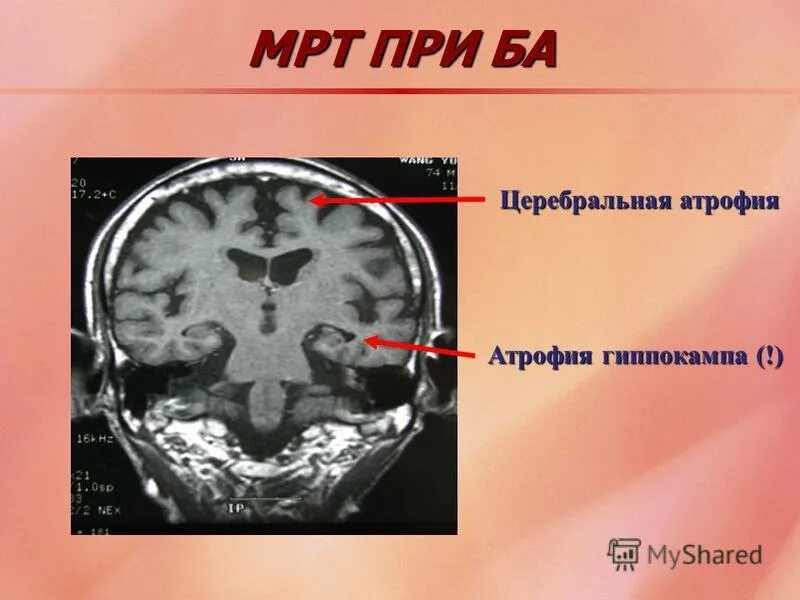 Атрофия головного мозга 1