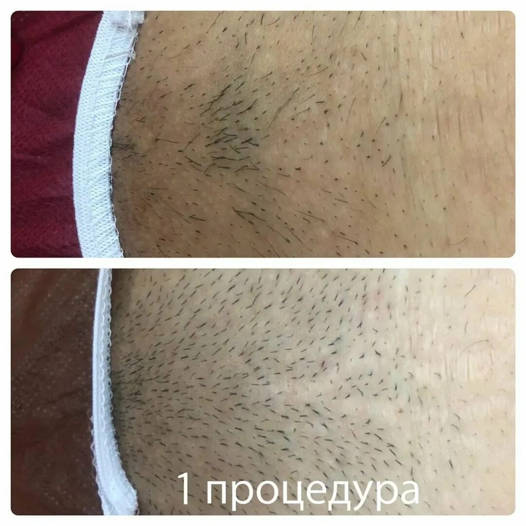 Удаление в интимных местах
