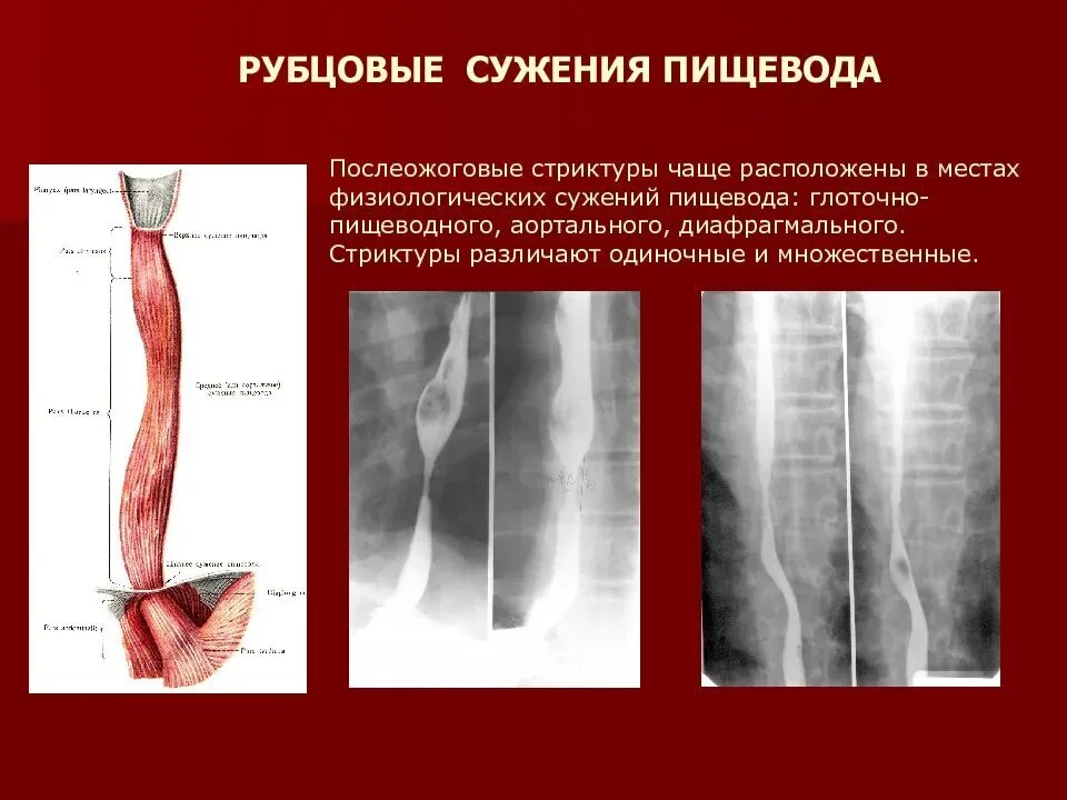 Рубцовые сужения пищевода