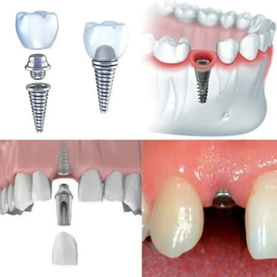 Через сколько можно вставить зубы. Одномоментная имплантация зубов этапы. Формирователь десны Nobel Biocare. Зубные имплантаты стелс. Этапы имплантации зубов абатмент.