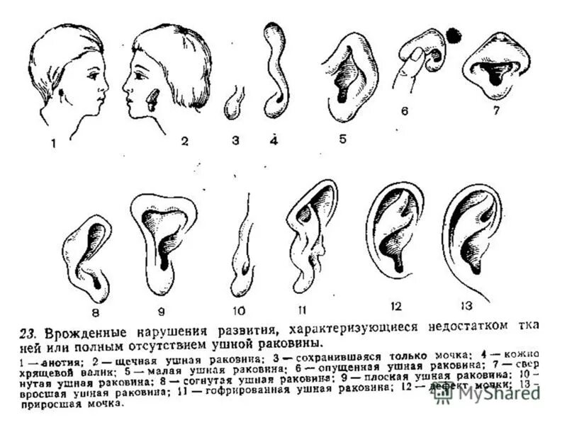 Ракушка форма женского органа. Пороки развития ушной раковины. Врожденная деформация ушной раковины. Ушные раковины человека криминалистика. Врожденные нарушения развития ушной раковины.