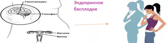 Эндокринное бесплодие. Женское бесплодие. Эндокринный фактор бесплодия. Причины эндокринного бесплодия. Бесплодие ростов