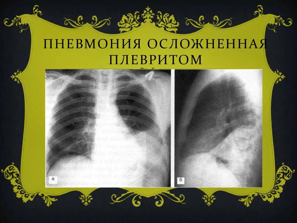 Плевральные осложнения. Пневмония осложненная плевритом. Воспаление легких с плевритом.