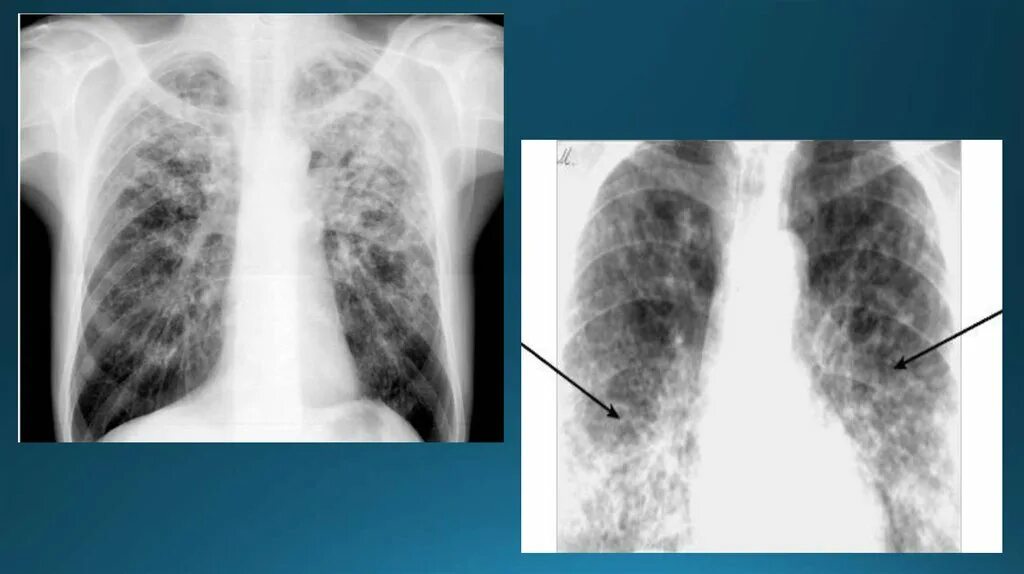 Острый диссеминированный туберкулез. Диссеминированный туберкулез рентген. Острый диссеминированный туберкулез рентген. Диссеминированный туберкулез легких рентген. Подострый диссиминированный туберкулёз рентген.