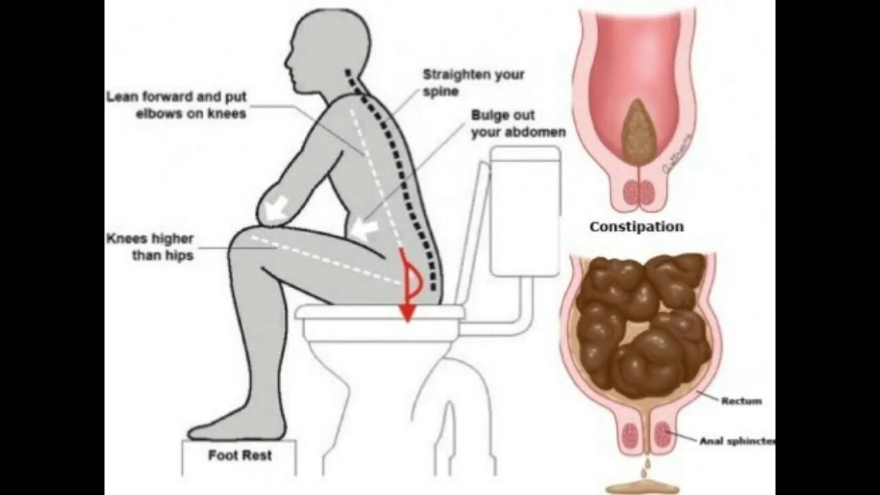 Запор. Правильная поза для дефекации.