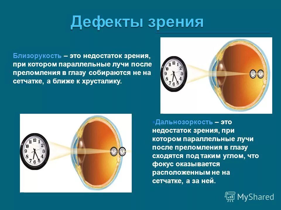 Зрение плюс это близорукость