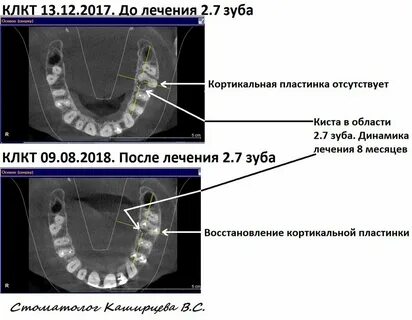 Кортикальная пластинка