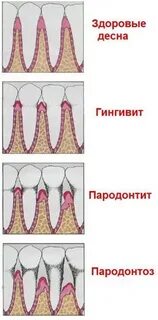 Пародонтоз лечение домашними средствами