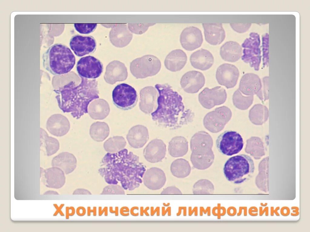 Тени Боткина Гумпрехта. Тени Боткина-Гумпрехта при хроническом лимфолейкозе это. Клетки лейколиза (тени Боткина-Гумпрехта). Тени Боткина Гумпрехта мазок крови. Хронический лимфолейкоз кровь