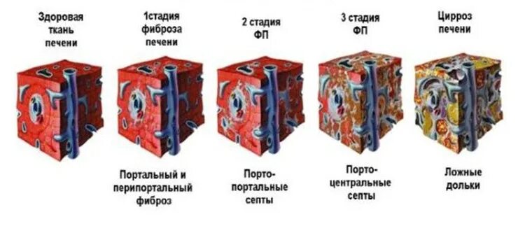 Фиброзные изменения печени. Фиброз печени f1 по шкале metavir. Фиброз печени f4 по metavir. Фиброз f3 по шкале метавир.